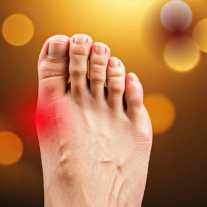 Bunion Therapy